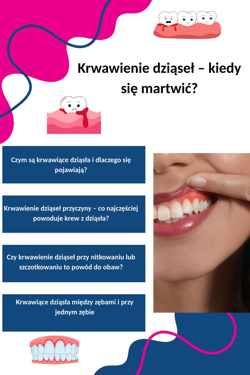 Czym są krwawiące dziąsła?