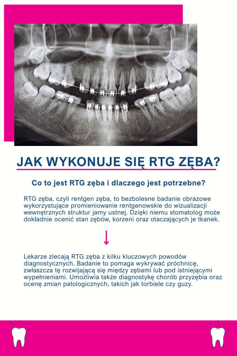 Jak wykonuje się RTG zęba?