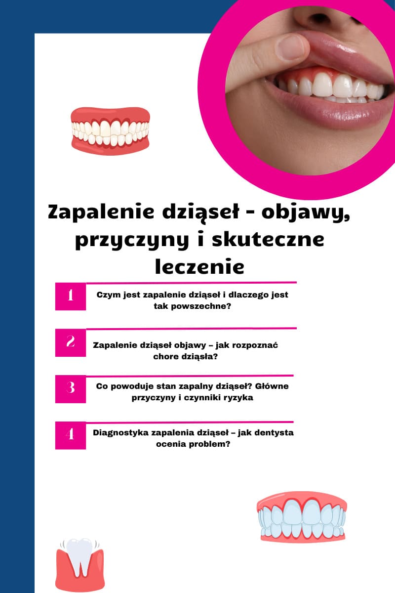 Czym jest zapalenie dziąseł?