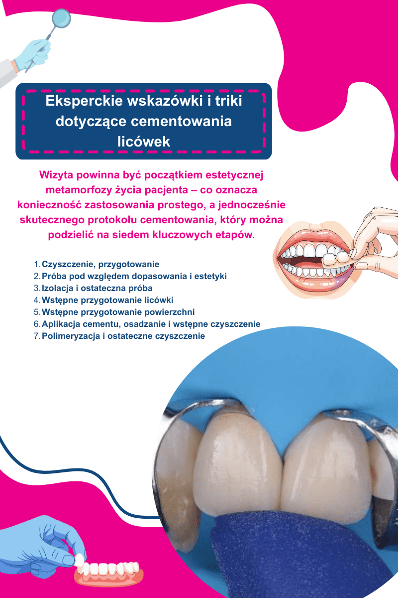 Wskazówki do licówek