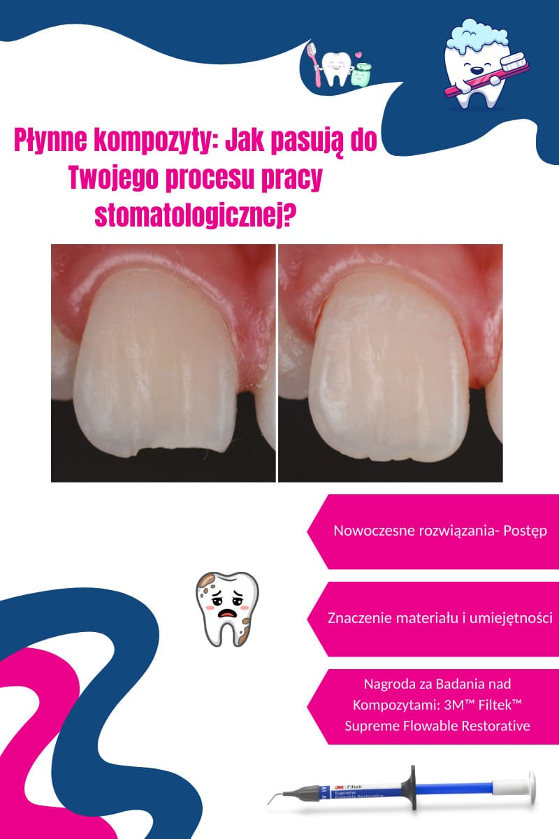 Płynne kompozyty: Jak pasują do Twojego procesu pracy stomatologicznej?